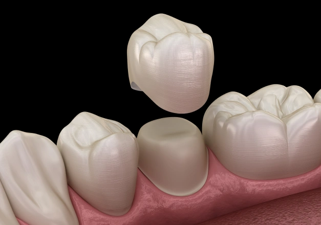 Dental implant crown placement demonstration showing tooth restoration on gum model.