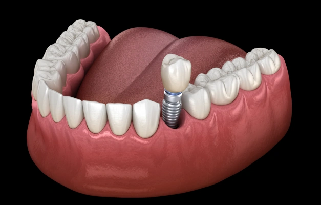 Dental implant model showing artificial tooth fixture in gum tissue against black background.